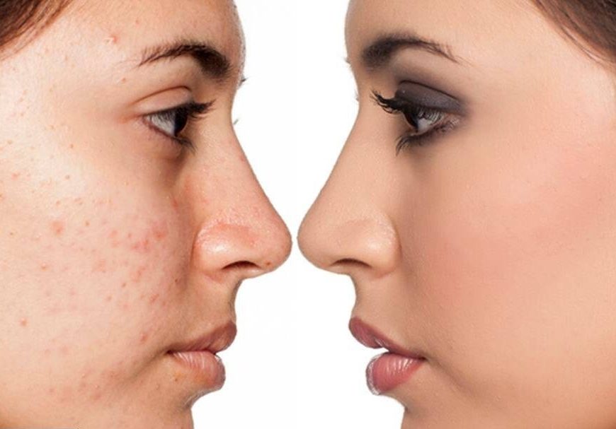 What is Active Acne?